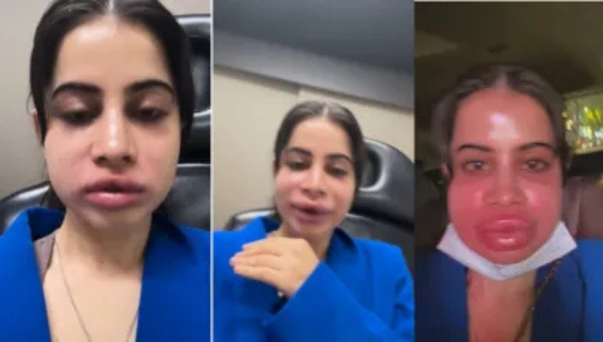 When the face changed in front of the camera: एक्ट्रेस की लिप फिलिंग से जुड़ा वीडियो बना चर्चा का कारण